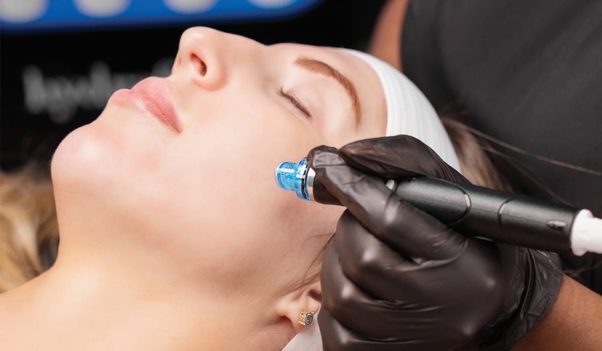 Microneedling-in-Leicester